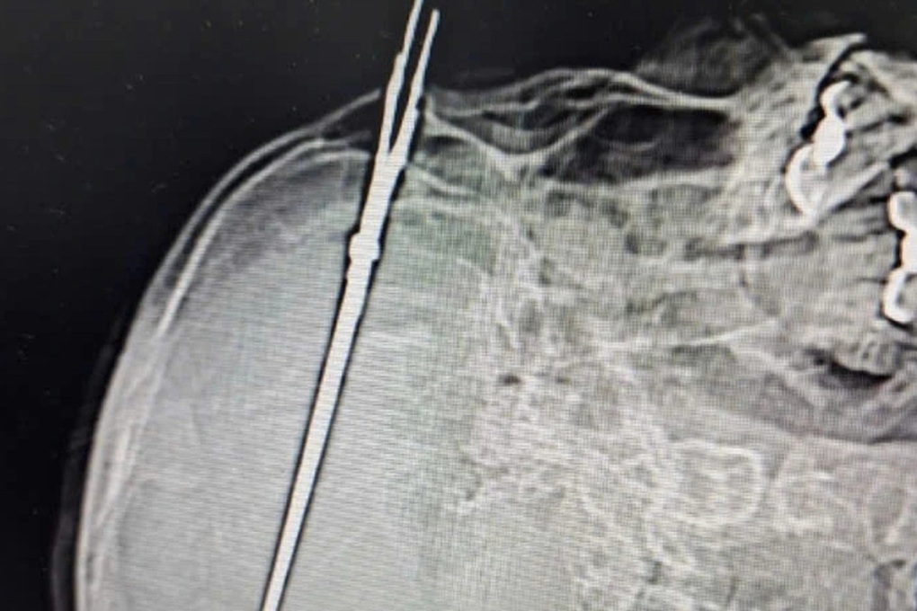 Lưỡi kéo dài 19cm cắm trong sọ não nam thanh niên - 1 Lưỡi kéo dài 19cm cắm trong sọ não nam thanh niên - 1