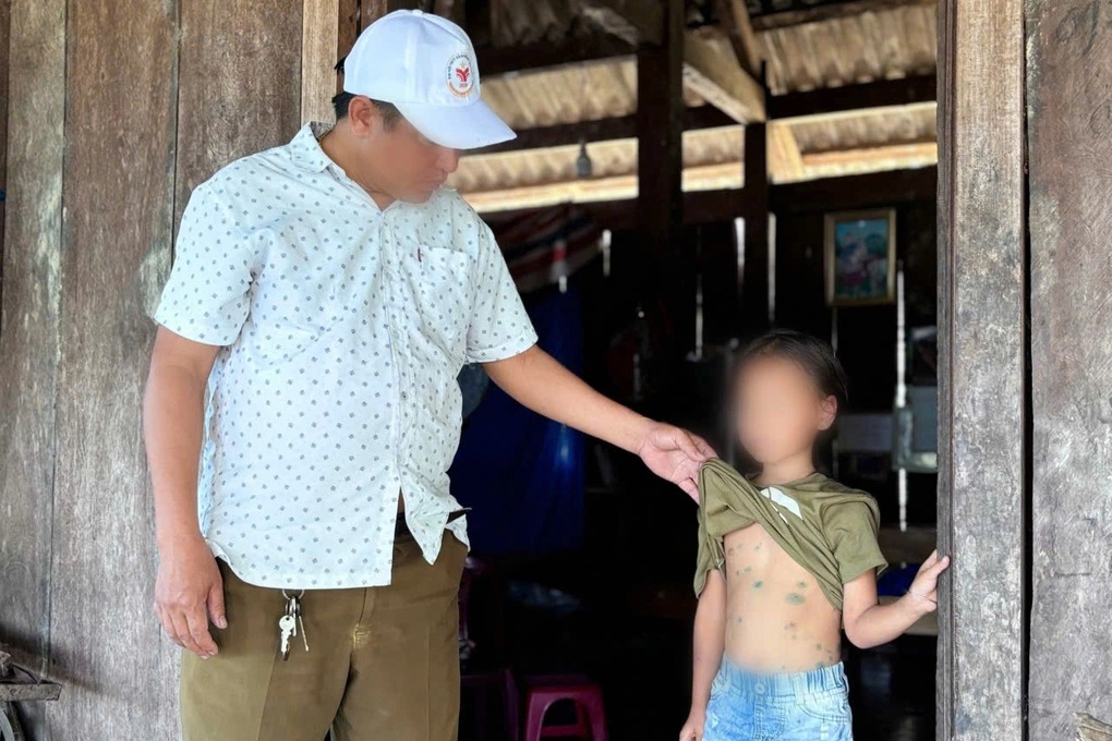 25 giáo viên, học sinh một điểm trường mắc thủy đậu - 1 25 giáo viên, học sinh một điểm trường mắc thủy đậu - 1