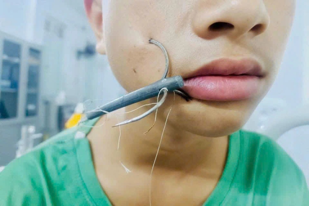 Bé trai bị lưỡi câu móc sâu vào mặt - 1 Bé trai bị lưỡi câu móc sâu vào mặt - 1