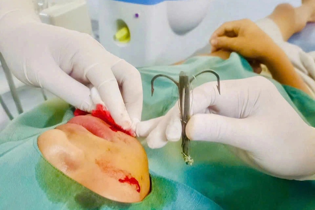 Bé trai bị lưỡi câu móc sâu vào mặt - 2 Bé trai bị lưỡi câu móc sâu vào mặt - 2
