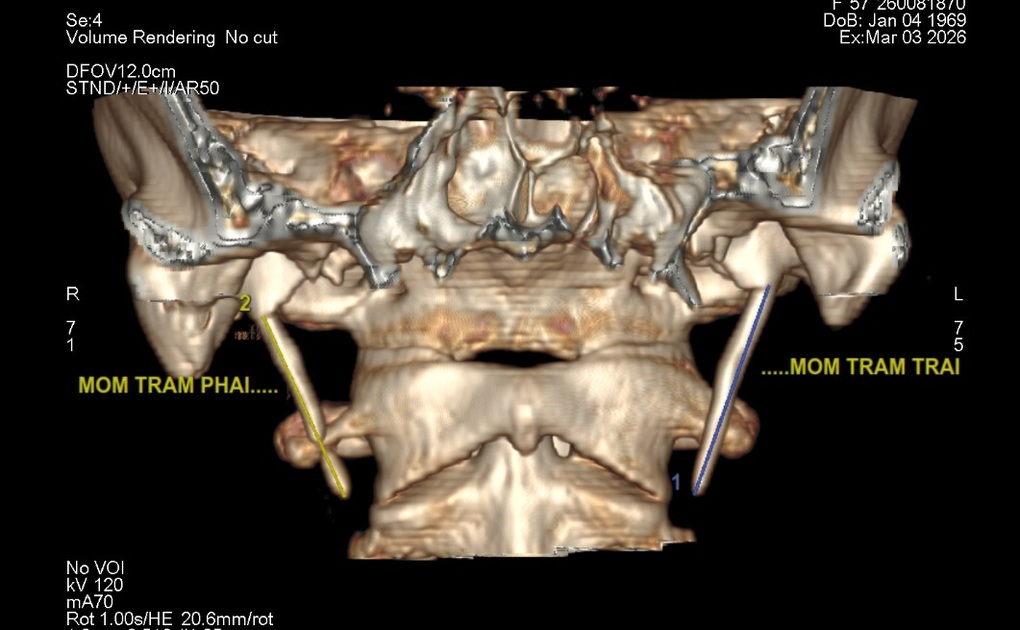 Đau họng&nbsp;dai dẳng&nbsp;6 năm, người phụ nữ bất ngờ phát hiện bệnh hiếm khi đi khám - 2