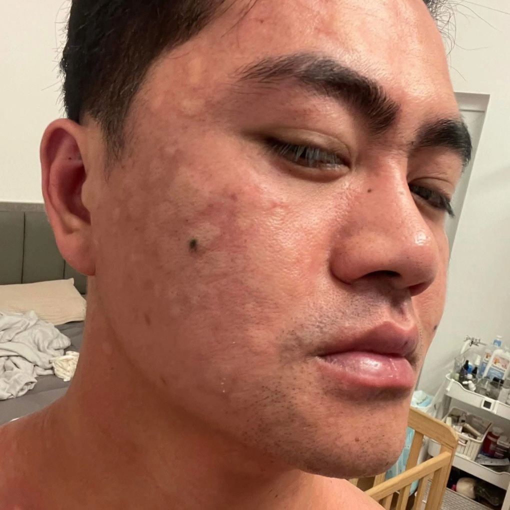 Chàng trai Hà Nội sưng mắt, khó thở vì món đặc sản khổ trước, sướng sau - 1