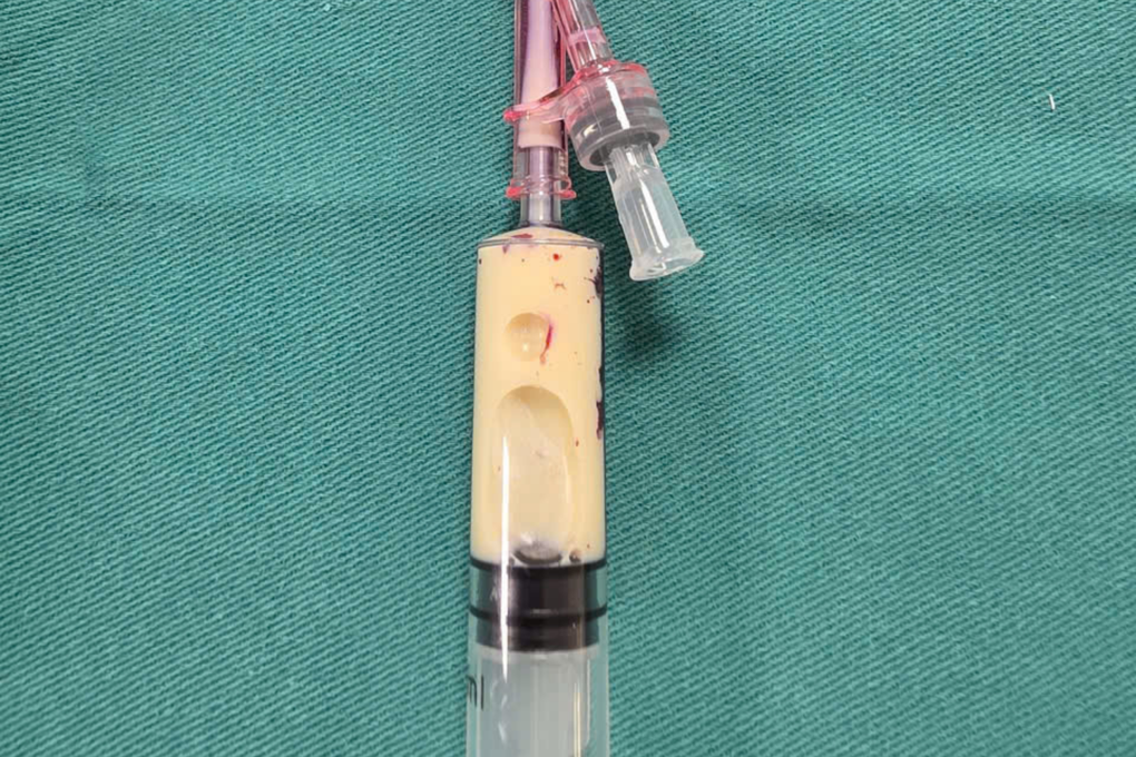 Mỡ máu tăng 100 lần, huyết tương trắng đục như sữa sau một buổi nhậu - 1 Mỡ máu tăng 100 lần, huyết tương trắng đục như sữa sau một buổi nhậu - 1