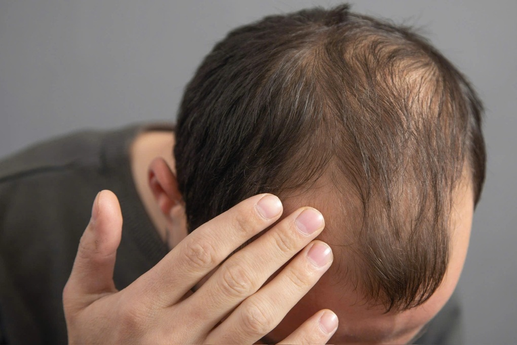 Mỹ thu hồi hàng nghìn chai thuốc chứa hoạt chất quen thuộc trị hói đầu - 2