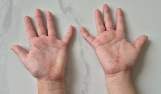 Bàn tay trẻ mắc tay chân miệng. Ảnh: Lê Phương