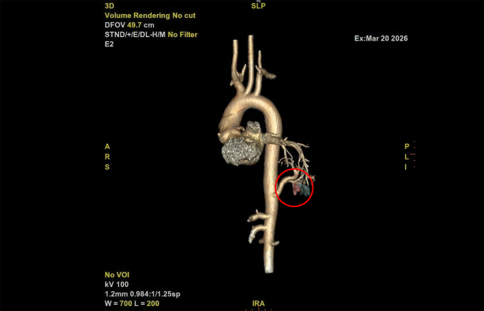 Ảnh chụp CT dựng hình 3D động mạch chủ của bệnh nhân cho thấy một nhánh động mạch bất thường (khoanh đỏ). Ảnh: Bệnh viện Đa khoa Tâm Anh