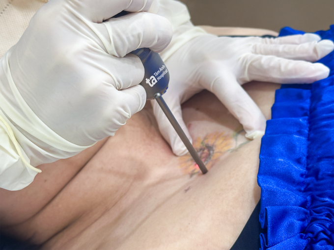 Bác sĩ sử dụng laser pico xóa xăm trên nền sẹo lồi cho chị Bình. Ảnh: Bệnh viện Đa khoa Tâm Anh