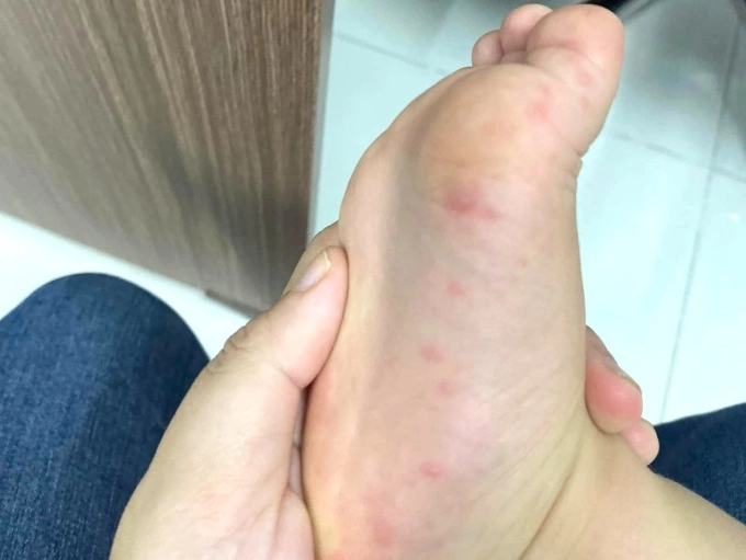 Những nốt mụn nước tay chân miệng mọc ở chân bé Gia Huy. Ảnh: Nhân vật cung cấp